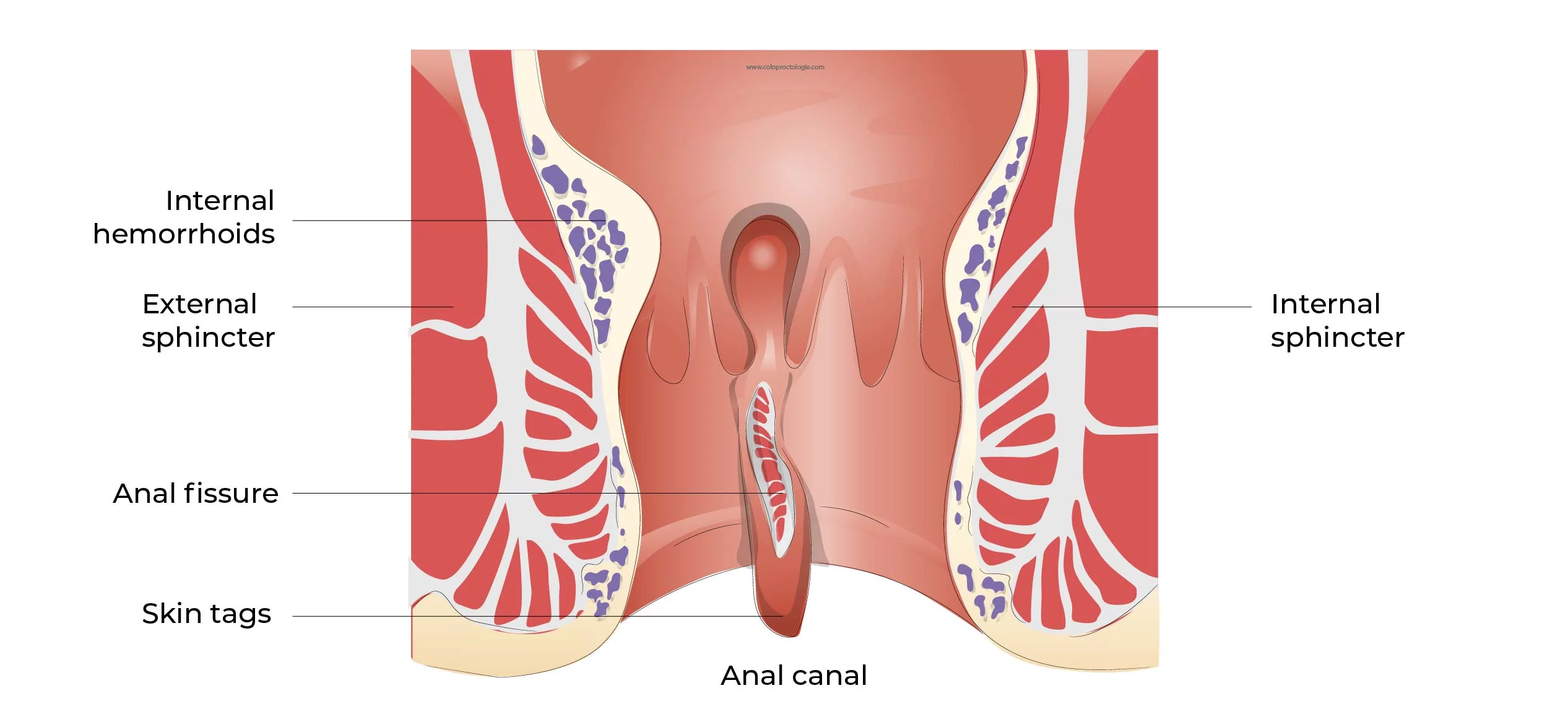 Fissure Diagram
