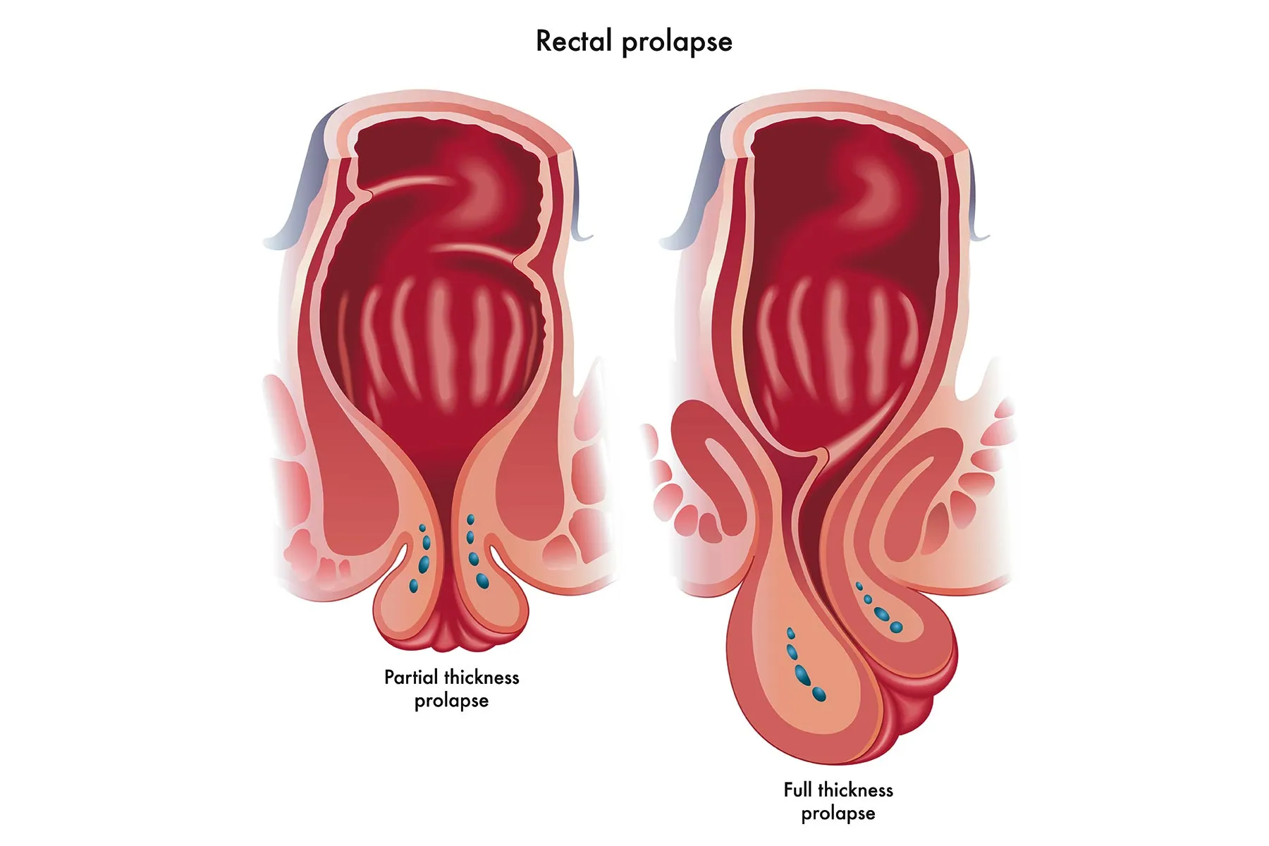 Rectal Prolapse Diagram